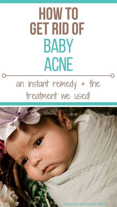 How To Get Rid Of Baby Acne An Instant Remedy The Baby Acne