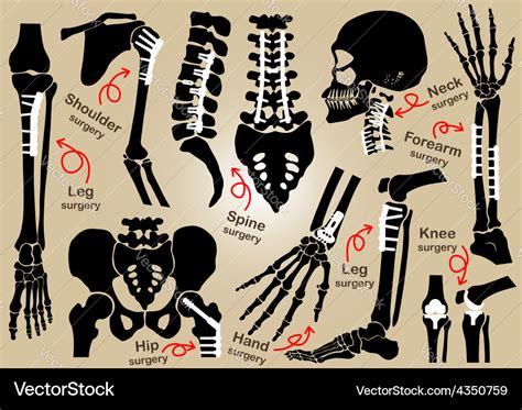 Collection Of Orthopedic Surgery Royalty Free Vector Image
