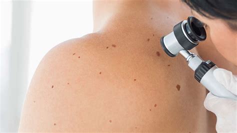 Skin Cancer Prevention And Early Detection