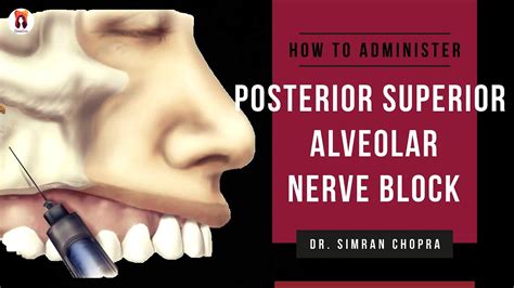 Posterior Superior Alveolar Nerve Block L Psa Nerve Block Technique L