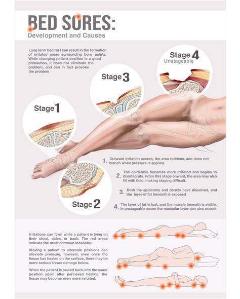 Bed Sore Stages Patient Guide On Behance