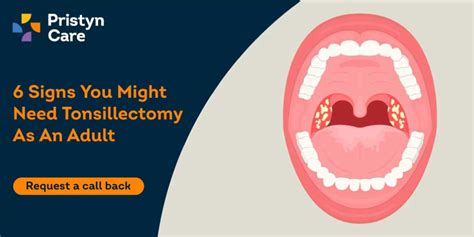 6 Signs You Might Need A Tonsillectomy As An Adult Pristyn Care