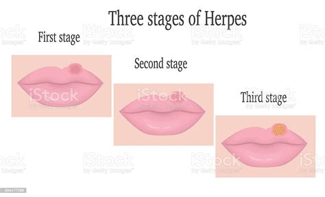 Herpes On The Lips Stock Illustration Download Image Now Istock