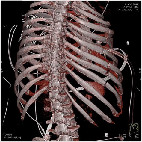 Multiple Rib Fractures In 2021 Rib Fracture Case Study