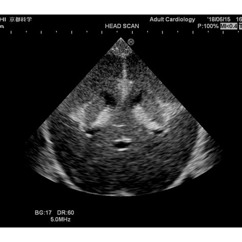 Ultrasound Neonatal Head Phantom Normal Type Kyoto Kagaku