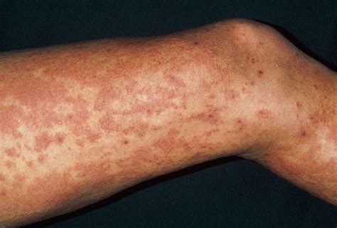 Pictures Of Hives Urticaria Different Types