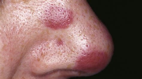 Hiv Rash What Does It Look Like And How Is It Treated