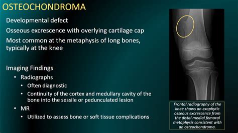 Cincy Kids Radiology On Twitter Osteochondromas Are Bony Excrescences