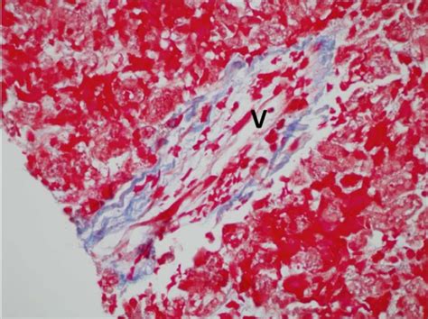 Sinusoidal Obstruction Syndrome Veno Occlusive Disease Livertox