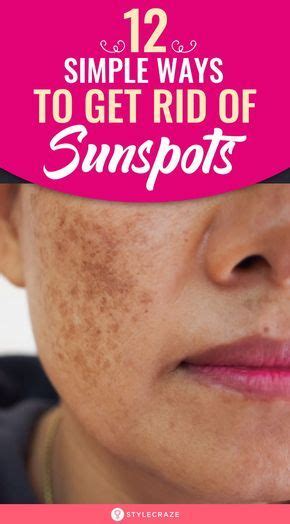 How To Get Rid Of Sunspots Sun Spots On Skin Sunspots On Face