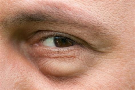 Alergia nos olhos principais causas sintomas e o que fazer Tua Saúde The Best Porn Website