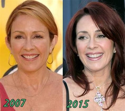 In a 2003 interview with people magazine, patricia heaton, star of the middle, said she had a tummy tuck and breast reduction for vanity . Patricia Heaton Plastic Surgery Before and After ...