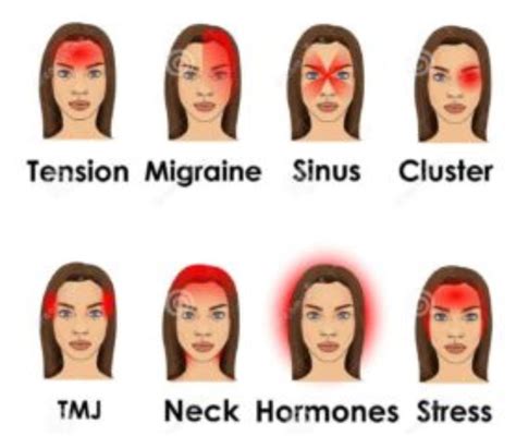Is Migraine And Head Pain Same Dr Sunayana Blog