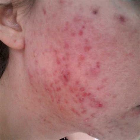 Acne Scar Treatment In Scottsdale Microneedling And Peels