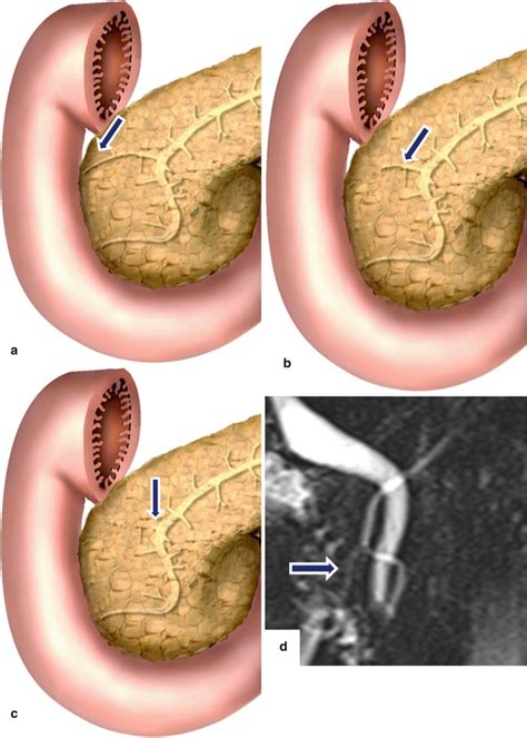 Anatomy Of The Pancreas Radiology Key