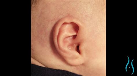 Infant Ear Molding With Earwell For Ear Deformity Youtube