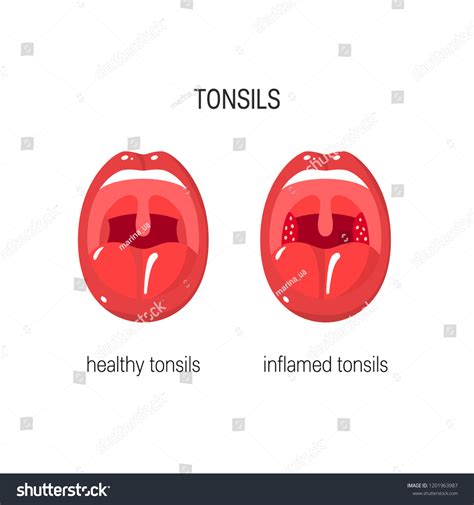 Healthy Infected Tonsils Vector Concept Simple Stock Vector Royalty