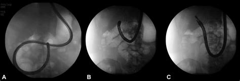 Eus Guided Cholecystoduodenostomy And Ercp In A Patient With Surgically
