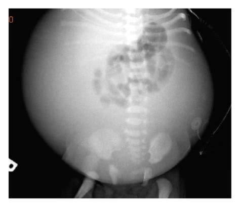 Abdominal X Ray Day Of Life 1 Distended Abdomen With Centralization