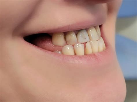 Denti Fissi In 6 Ore Implantologia A Carico Immediato Wedental Care