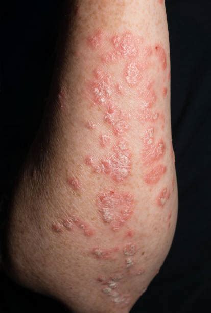 Psoriasis On Arm Stock Photos Pictures And Royalty Free Images Istock