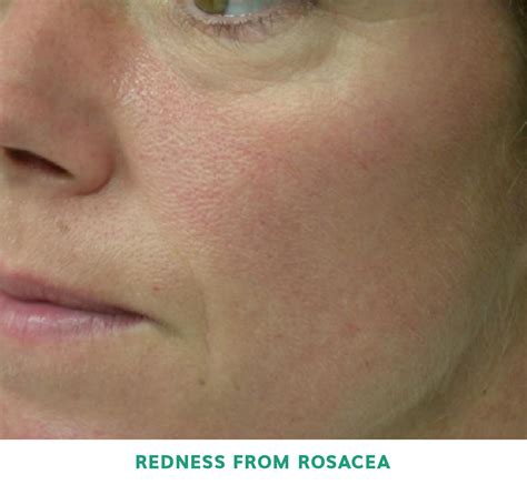 Rosacea Treatment In Singapore Expert Treatment