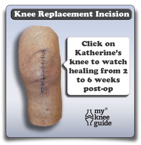 Partial Knee Replacement Scar