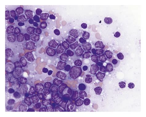 Case 2 Peripheral Blood And Bone Marrow Biopsy Wright Giemsa Stained