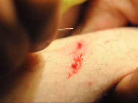 Had an ingrown hair that i didn't remove right away. Gross Popping a Pus Pocket Caused By an Ingrown Hair - YouTube
