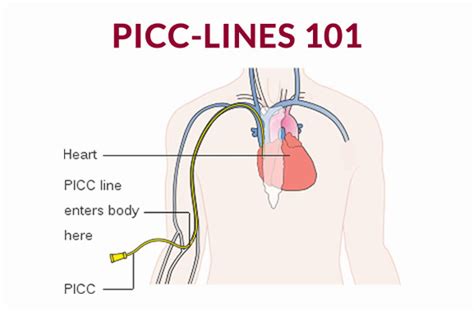 Picc Line Access Device Wiring Diagrams