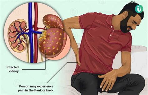 Kidney Infection Symptoms Causes Treatment Medicine Prevention