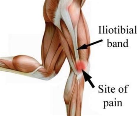 Iliotibial Band Friction Syndrome Sport And Spine Rehab Clinic