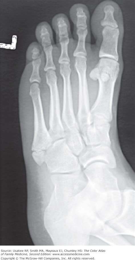 Avulsion Fracture 5th Metatarsal