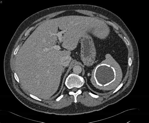 Calcified Splenic Cyst Spleen Case Studies Ctisus Ct Scanning