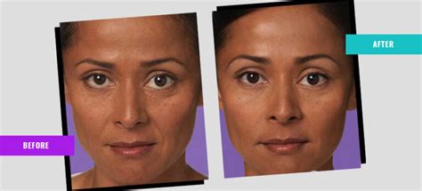 Juvederm Treatment Dr Sumans Cosmetic Surgery And Skin Clinic