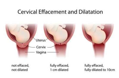 Dilation Of The Cervix What You Need To Know Bellybelly
