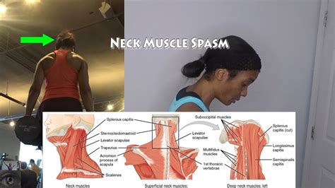 Neck Muscle Spasm Update Youtube