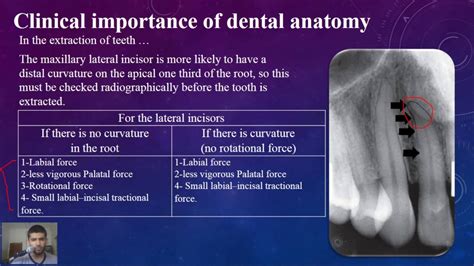 Dental Anatomy At A Glance Lec 2 Maxillary Lateral Incisor Youtube