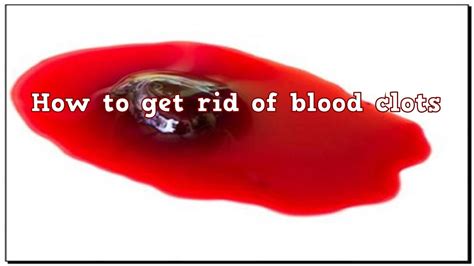 How To Prevent And Get Rid Of Blood Clots Home Remedy Clear