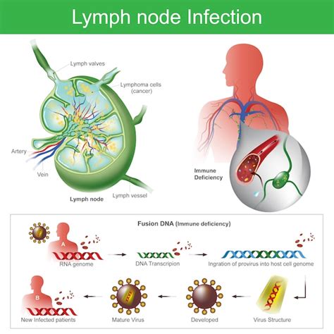 Lymph Node Infection The Lymph Nodes Are Infected Failure Of The