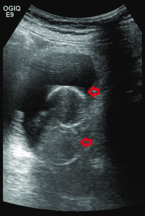 Ultrasound Scan Of Urinary Bladder Performed In August 2015 Eight