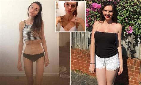 Former Anorexic Whose Weight Plummeted To SIX Stone Turned Life Around After Shock Diagnosis