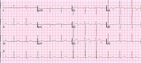 Dr Smith S Ecg Blog Wellens Waves Are Not Equivalent To Free Nude