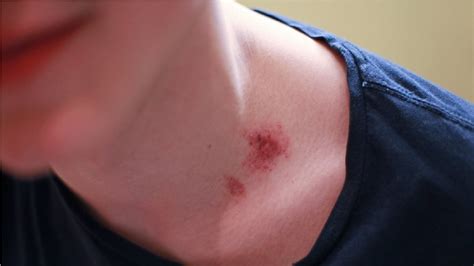 How To Get Rid Of A Hickey In 1 Hour How To Give Someone A Hickey
