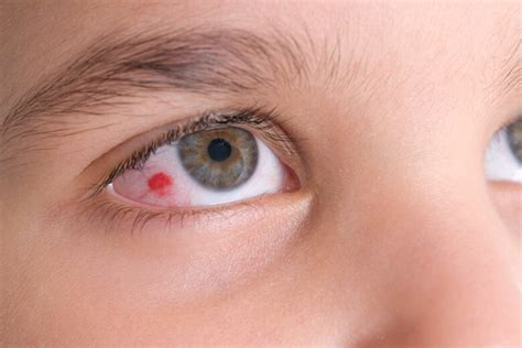 Eye Infections All You Need To Know Your