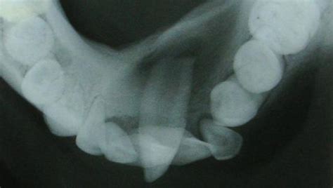 Unusual Intraosseous Transmigration Of Impacted Tooth Report Of Three