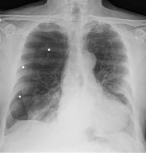 Chest X Ray Showing Right Pneumothorax Asterisk Download