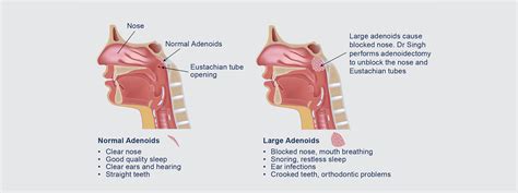Adenoidectomy By Dr Singh For Large Adenoids In Children Lakeview