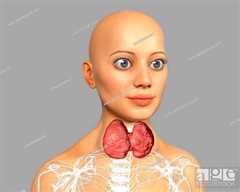 Hyperthyroidism 3d Illustration Showing Enlarged Thyroid Gland And