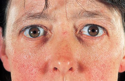 Graves Disease The Lancet